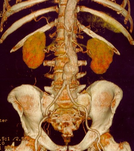 AneurysmAorta