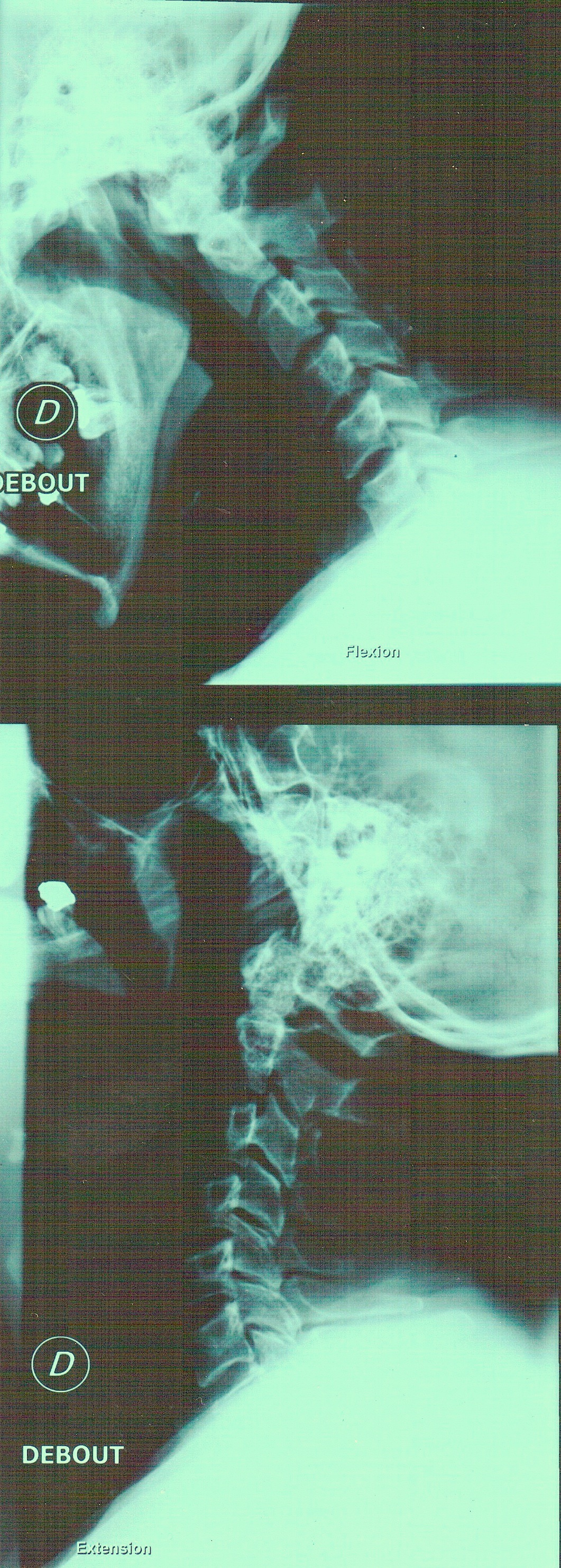 Rachis cervical en flexion et extension
