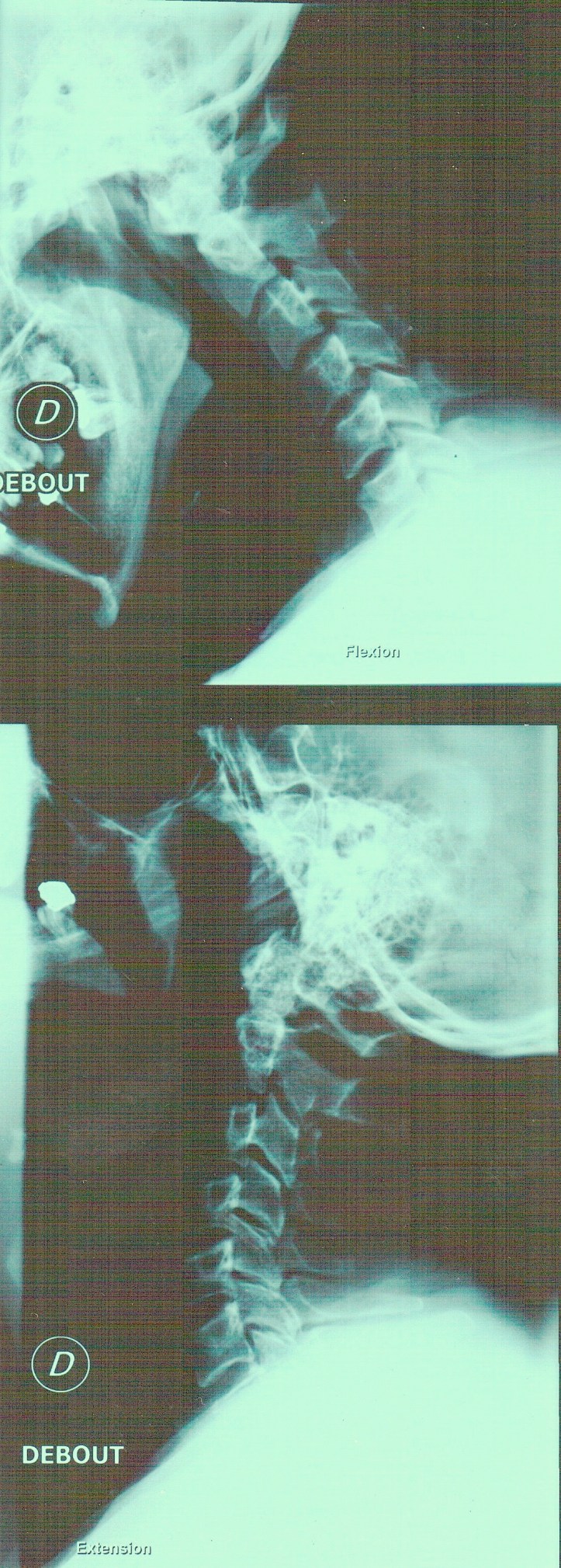 Rachis cervical en flexion et extension