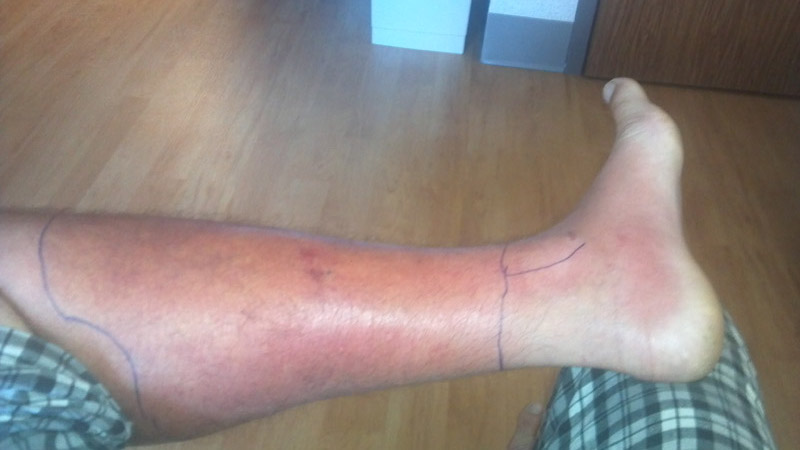 Cellulitis_Of_The_Leg