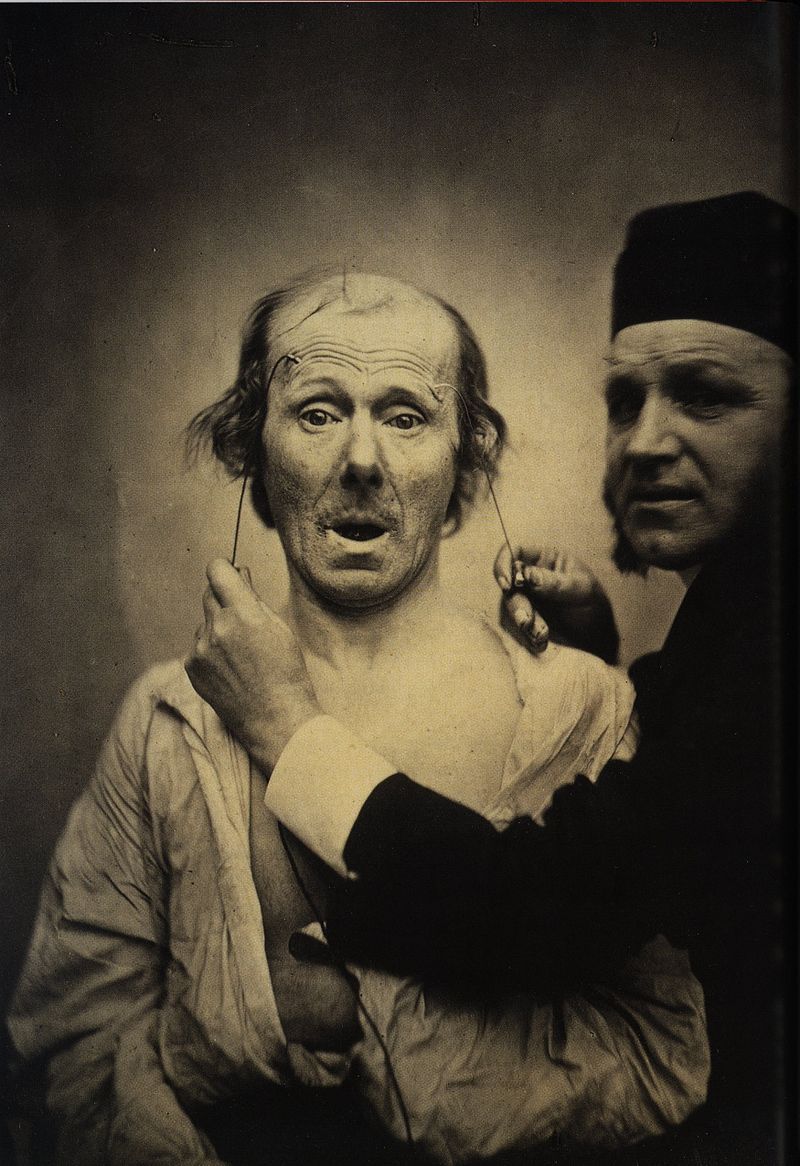 Guillaume_Duchenne_de_Boulogne_performing_facial_electrostimulus_experiments_(3)